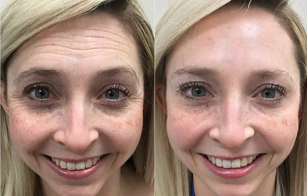Antes e depois: rugas na testa e ao redor dos olhos suavizadas